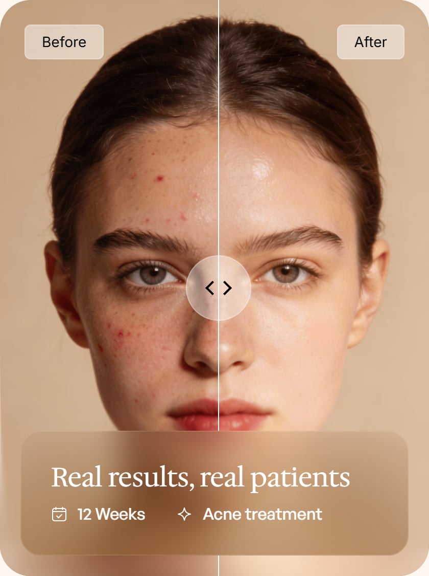Before and after: real results, real patients — 12 weeks of acne treatment